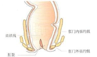 福州女性肛裂要如何治疗?