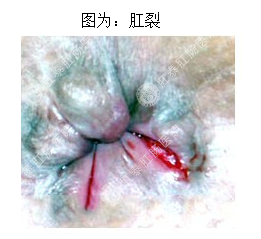 福州有什么方法治疗肛裂不错?